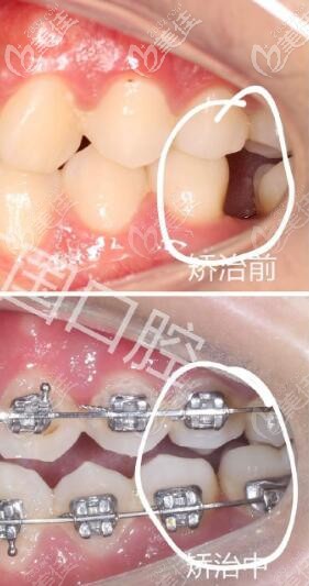 蘭州牙王國(guó)數(shù)字化口腔 正畸關(guān)閉間隙 蘭州牙王國(guó)數(shù)字化口腔 正畸關(guān)閉間隙