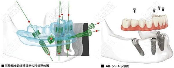 3D導(dǎo)板數(shù)字種植牙的優(yōu)勢(shì) 3D導(dǎo)板數(shù)字種植牙的優(yōu)勢(shì)