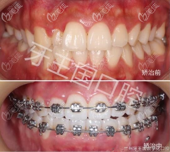 蘭州牙王國(guó)數(shù)字化口腔正畸<span style= 蘭州牙王國(guó)數(shù)字化口腔正畸<span style=