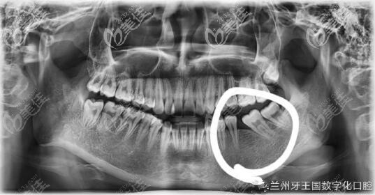 智齒拉過(guò)來(lái)當(dāng)磨牙 蘭州牙王國(guó)口腔 智齒拉過(guò)來(lái)當(dāng)磨牙 蘭州牙王國(guó)口腔