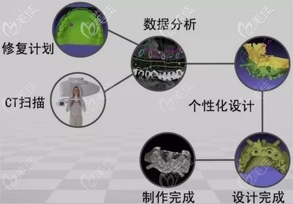 3D數(shù)字化種植導(dǎo)板做種植牙的過程 3D數(shù)字化種植導(dǎo)板做種植牙的過程
