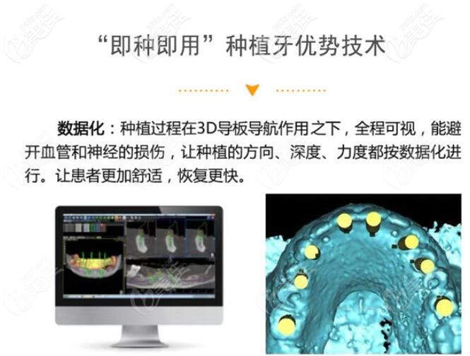 南京卡瓦口腔即刻種植牙怎么樣 南京卡瓦口腔即刻種植牙怎么樣