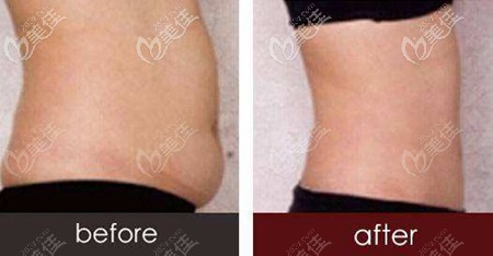北韓韓美做腰腹吸脂前后效果對比