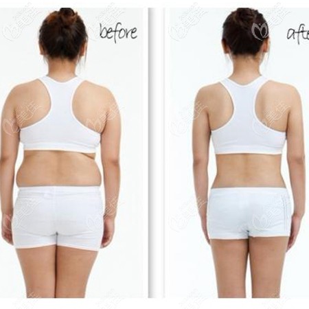 北海美秀中禾吸脂案例