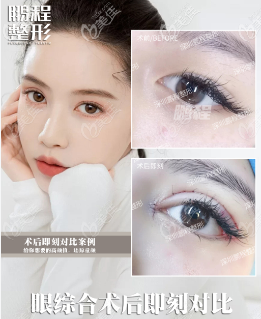 深圳眼綜合就選鵬程醫(yī)院,恢復(fù)效果好價(jià)格還不貴 深圳眼綜合就選鵬程醫(yī)院,恢復(fù)效果好價(jià)格還不貴