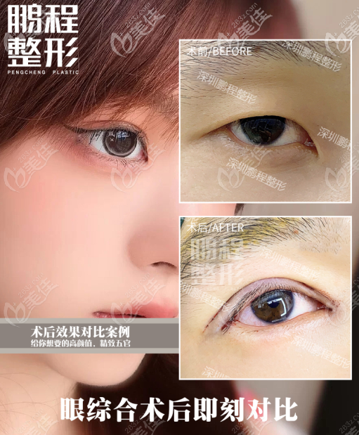 深圳鵬程醫(yī)院眼綜合案例效果圖 深圳鵬程醫(yī)院眼綜合案例效果圖