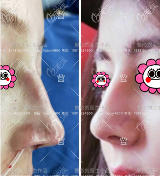 北京美憬<!--<i data=20240703-sp></i>-->鼻修復(fù)案例 北京美憬<!--<i data=20240703-sp></i>-->鼻修復(fù)案例