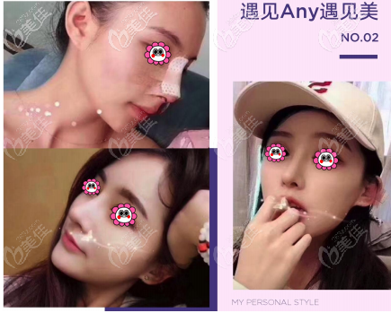 北京美憬<!--<i data=20240703-sp></i>-->鼻綜合案例 北京美憬<!--<i data=20240703-sp></i>-->鼻綜合案例