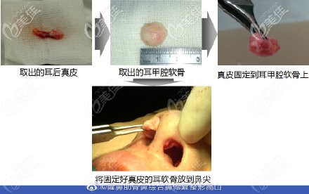 真皮墊鼻尖的過程