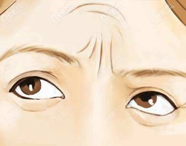 自體脂肪填充眉間紋 自體脂肪填充眉間紋