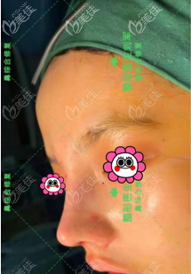 找北京做鼻綜合好的<!--<i data=20240703-sp></i>-->做鼻修復(fù)術(shù)后即刻照 找北京做鼻綜合好的<!--<i data=20240703-sp></i>-->做鼻修復(fù)術(shù)后即刻照