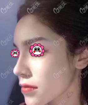 找北京做了鼻綜合修復(fù)手術(shù)后改善了之前鼻子瞧著好假的問(wèn)題