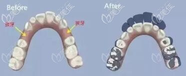 牙齒矯正是否拔牙 牙齒矯正是否拔牙