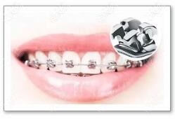 牙齒矯正 牙齒矯正