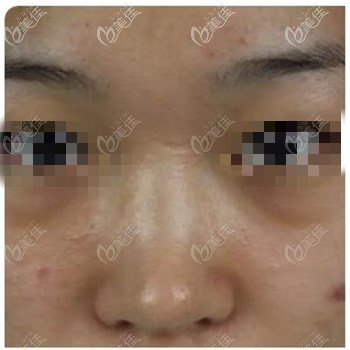 山根低適合假體還是鼻綜合？