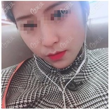 不知道山根低適合哪種隆鼻的，火速看我在新鄉(xiāng)奕諾美膨體隆鼻經(jīng)歷再決定