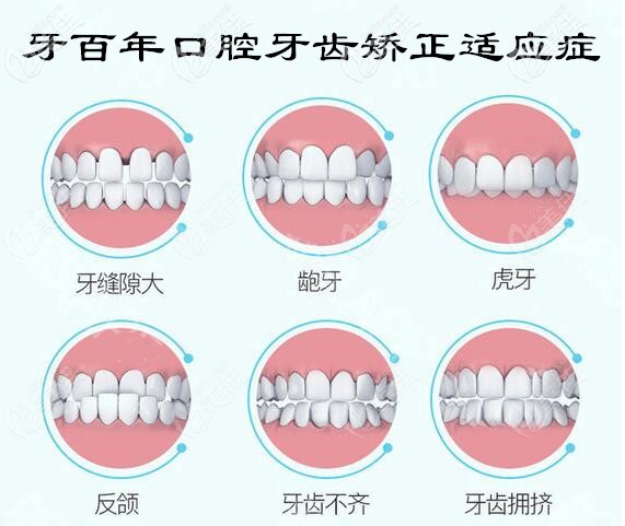 南寧牙百年口腔牙齒矯正適應(yīng)癥