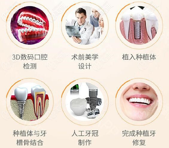 南寧牙百年口腔數(shù)字化種植牙流程