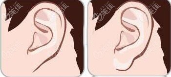 玻尿酸豐耳唇對比效果圖