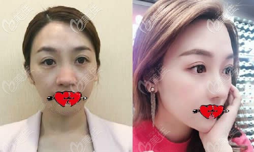 我做耳后筋膜包裹硅膠假體隆鼻一年后效果對比照片