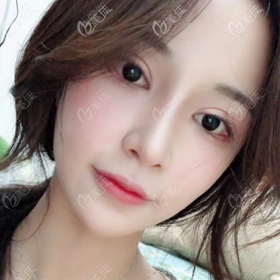 廣州韓妃鼻阿芙洛美鼻術(shù)后3個(gè)月 廣州韓妃鼻阿芙洛美鼻術(shù)后3個(gè)月