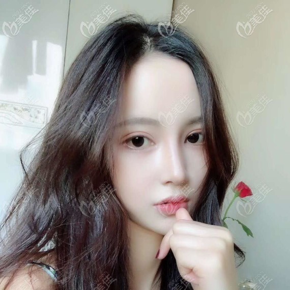 廣州韓妃鼻阿芙洛美鼻術(shù)后25天<span style= 廣州韓妃鼻阿芙洛美鼻術(shù)后25天<span style=