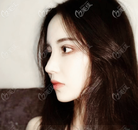 廣州韓妃阿芙洛美鼻術(shù)后6個(gè)月 廣州韓妃阿芙洛美鼻術(shù)后6個(gè)月