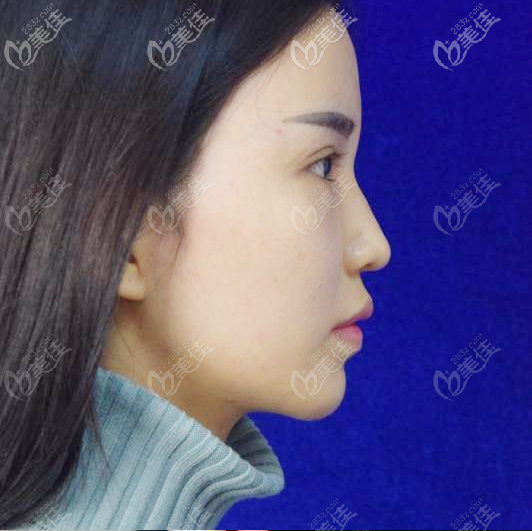 來廣州韓妃做阿芙洛美鼻術(shù)前照片 來廣州韓妃做阿芙洛美鼻術(shù)前照片