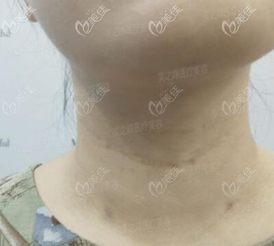 打完嗨體去頸紋術后5天恢復效果照 打完嗨體去頸紋術后5天恢復效果照