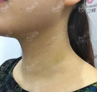 嗨體去頸紋術后10天恢復照 嗨體去頸紋術后10天恢復照