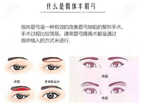 假體豐眉弓的手術(shù)原理