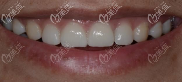 聽說牙齒稀疏牙縫大不做矯正也可以?做貼面的效果也太贊了吧