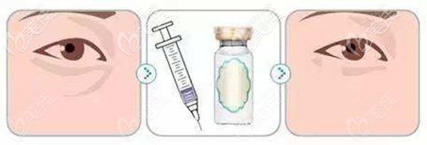 注射填充淚溝術后的