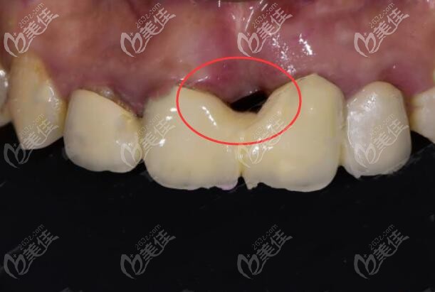 前門牙種植牙失敗案例圖