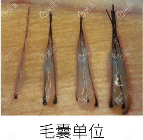 一個(gè)毛囊單位里有1-4根頭發(fā)不等