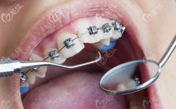 佛山拜爾口腔的傳統(tǒng)鋼絲矯正價格直降千元,比用醫(yī)?？▓箐N還劃算呢