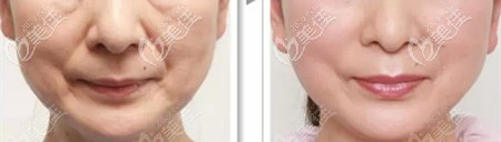 做熱瑪吉前后效果對(duì)比 做熱瑪吉前后效果對(duì)比