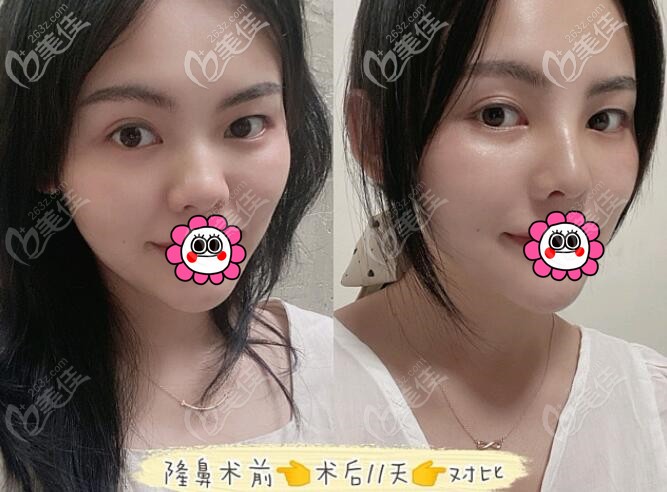 成都素美隆鼻后對比效果
