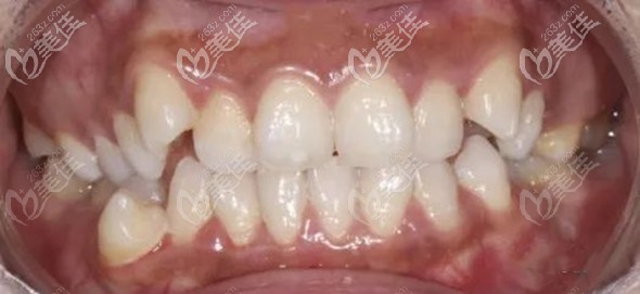 二度牙齒擁擠不齊 二度牙齒擁擠不齊