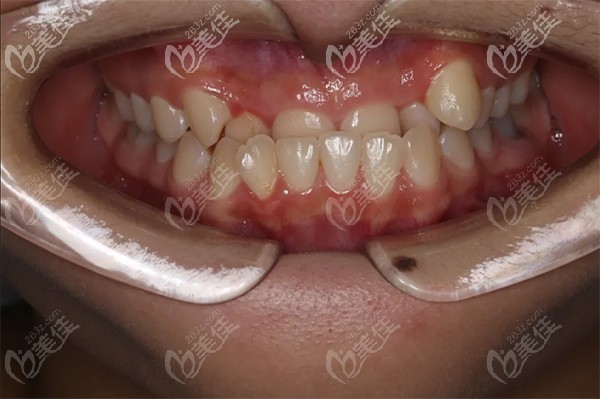 柳女士牙齒矯正前的狀態(tài) 柳女士牙齒矯正前的狀態(tài)