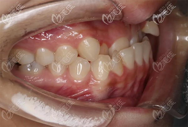 柳同學(xué)口腔檢查后的總體情況 柳同學(xué)口腔檢查后的總體情況