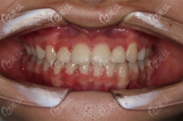 20歲學(xué)生分享：在北京牙管家佩戴唇側(cè)金屬固定托槽矯正的經(jīng)歷和價格