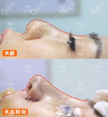 沈陽杏林朱石江肋軟骨隆鼻真人案例對比圖