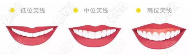 不同程度的微笑曲線 不同程度的微笑曲線