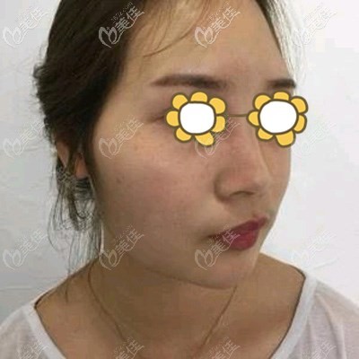 做黃金微雕前顧客的臉上明顯肉多 做黃金微雕前顧客的臉上明顯肉多