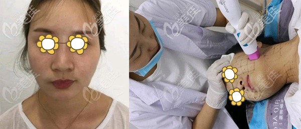 溶脂后皮膚松弛做熱瑪吉改善 溶脂后皮膚松弛做熱瑪吉改善