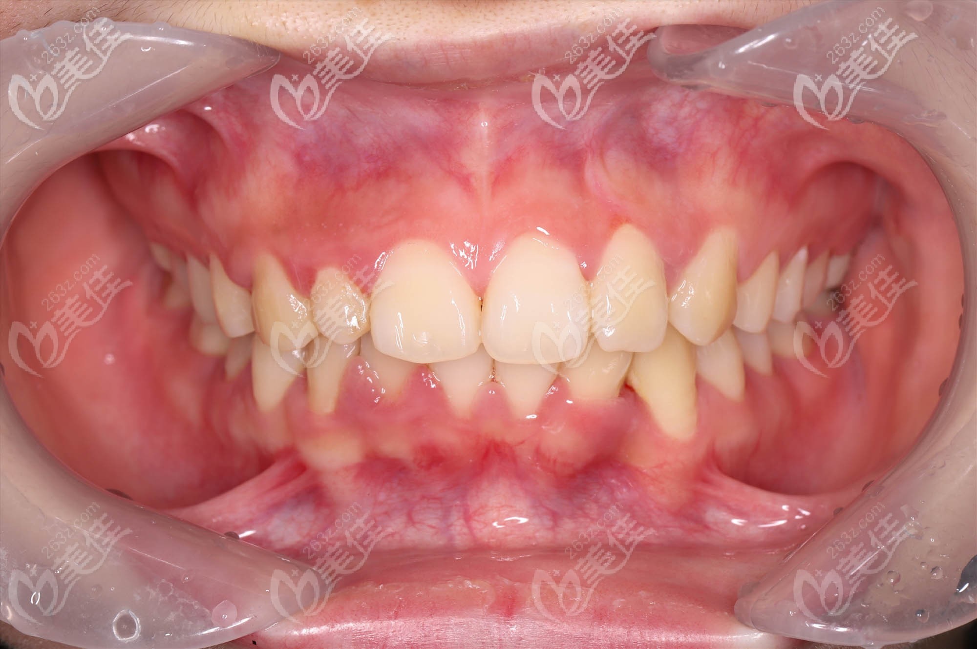 23歲妹子重度牙列擁擠不到2年前牙就排齊啦,戴的是鋼絲自鎖矯正器