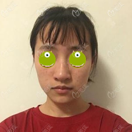 膨體隆鼻失敗后找到了范浚澤醫(yī)生 膨體隆鼻失敗后找到了范浚澤醫(yī)生