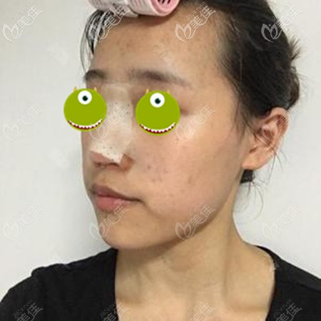 在鄭大<!--<i data=20240703-sp></i>-->院做鼻修復(fù)一周后 在鄭大<!--<i data=20240703-sp></i>-->院做鼻修復(fù)一周后