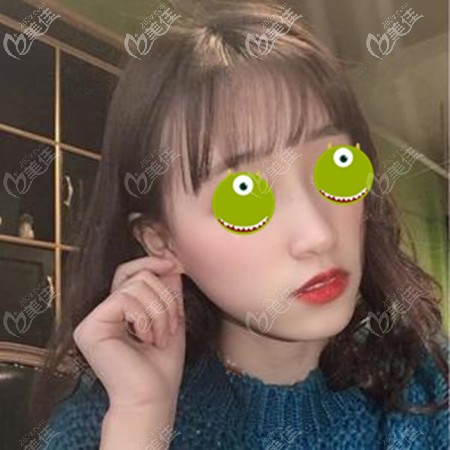 隆鼻失敗后將膨體換成了生科硅膠假體 隆鼻失敗后將膨體換成了生科硅膠假體